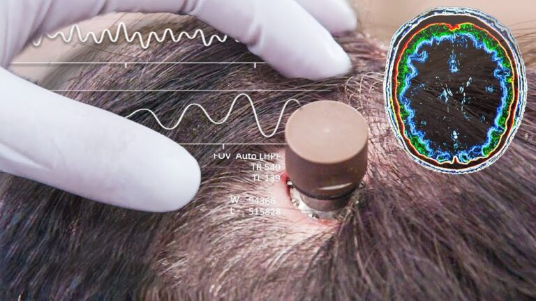 Novo Implante cerebral de Elon Musk inicia testes em humanos
