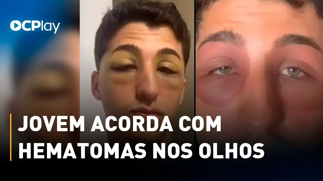 Jovem acorda com hematomas nos olhos