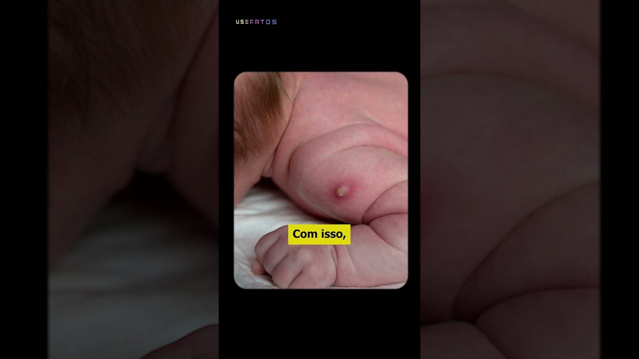 Por que a vacina BCG deixa uma marca no braço?