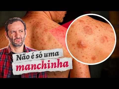 POR QUE o SARAMPO é PERIGOSO? COMO se PROTEGER?